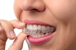 hand holding Invisalign clear teeth aligners in mouth, Prior Lake, MN Invisalign